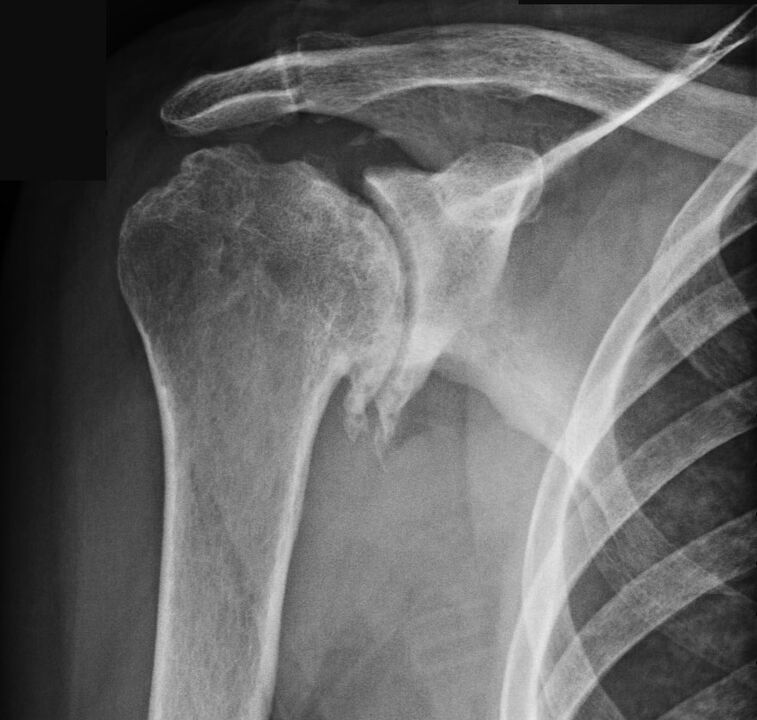 X-ray shows arthrosis in the shoulder