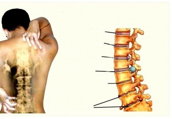 Stage of cervical osteochondrosis