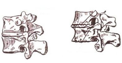 Stage of development of cervical osteochondrosis
