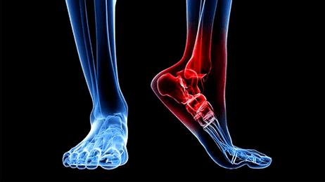 Ankle joint arthrosis