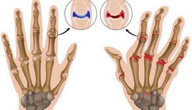 The main difference of arthritis and arthrosis