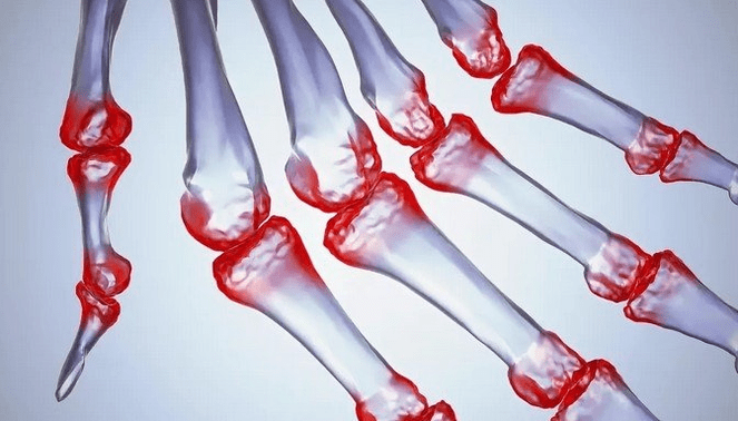 Pain in the finger joint