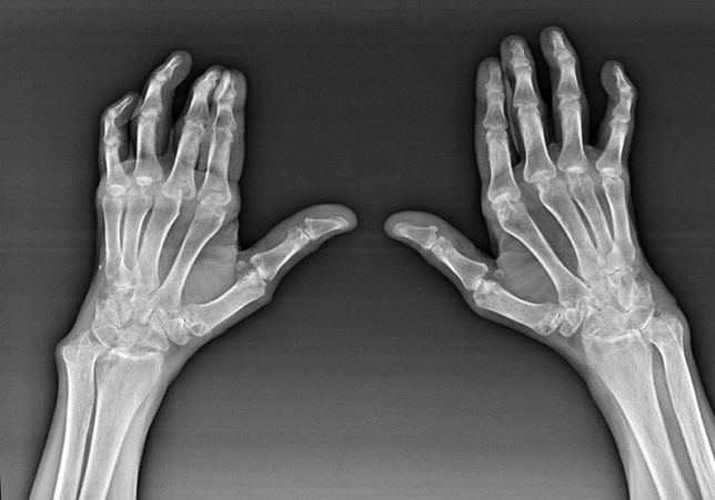 The diagnostics of the finger joint