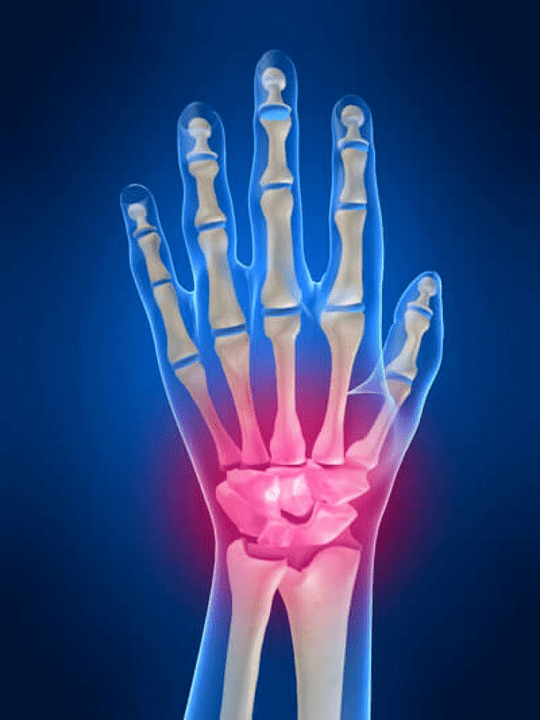 Wrist combination arthritis