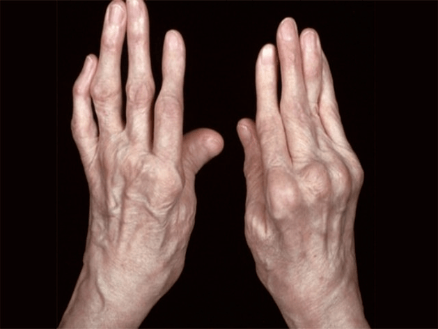 arthritis as the cause of pain in the finger joint