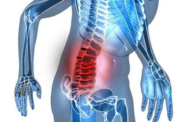 Defects of the spine in the fourth stage of lumbar osteochondrosis