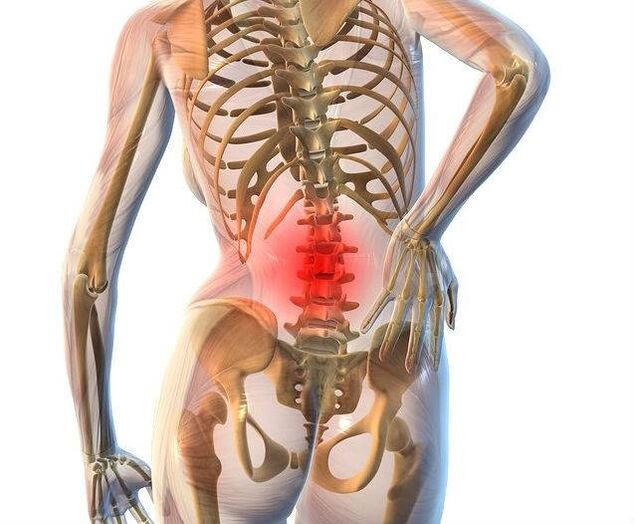 Osteochondrosis of the lumbar spine