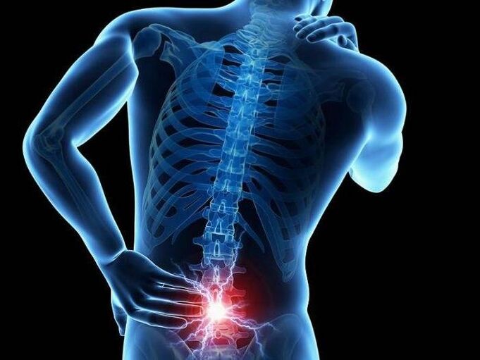 With radiculitis, pinched nerve roots cause sharp pain in the lower back