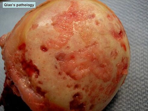 Cartilaginous surfaces affected by arthrosis