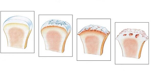 Healthy joints and 3 degrees of arthrosis development