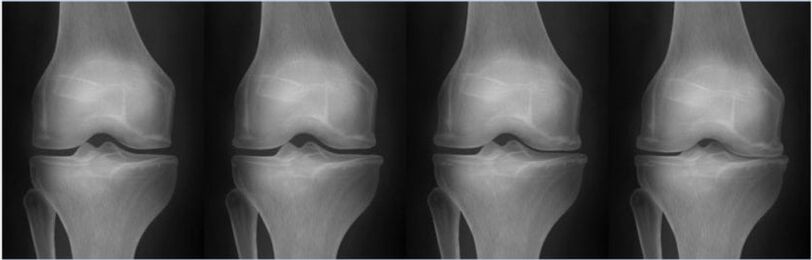 Stage of arthrosis according to the Kellgren-Lawrence classification
