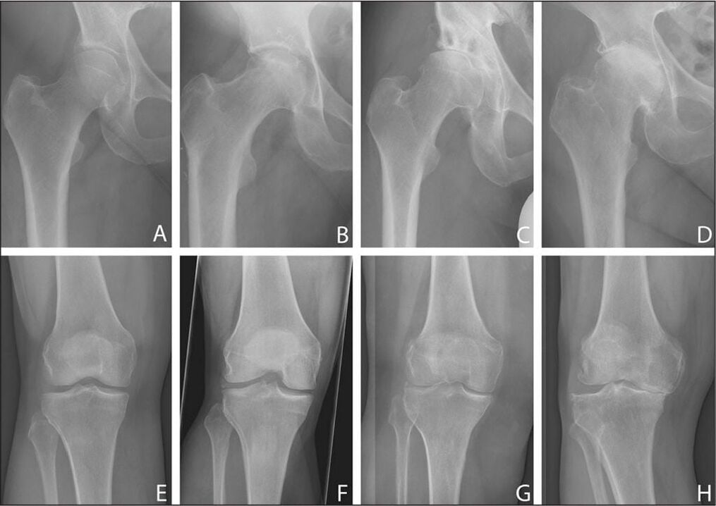 The stage of development of joint arthrosis on x-ray